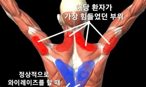 shoulder impingement syndrome