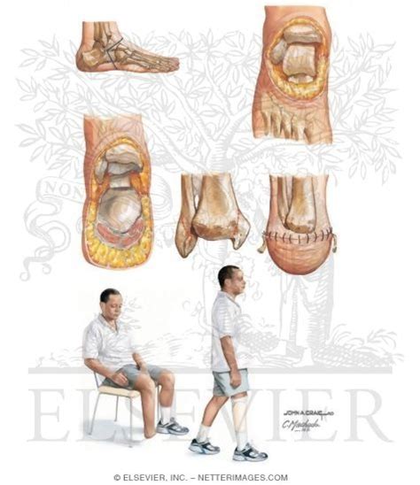 Ankle Disarticulation (Syme Amputation)