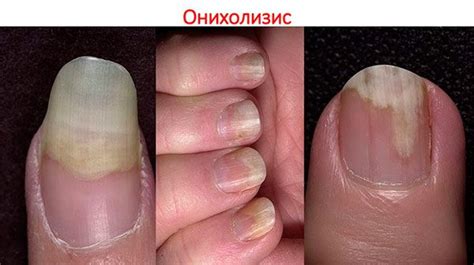Онихолизис: что делать, если ноготь отслаивается