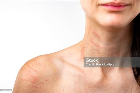 Allergy Symptoms Red Rashes On The Neck And Arms Itchiness From ...