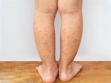 Острая крапивница: первая помощь при аллергической реакции | MedAboutMe