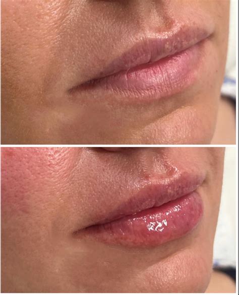 Lip Filler: A Comprehensive Guide | House of Beauty