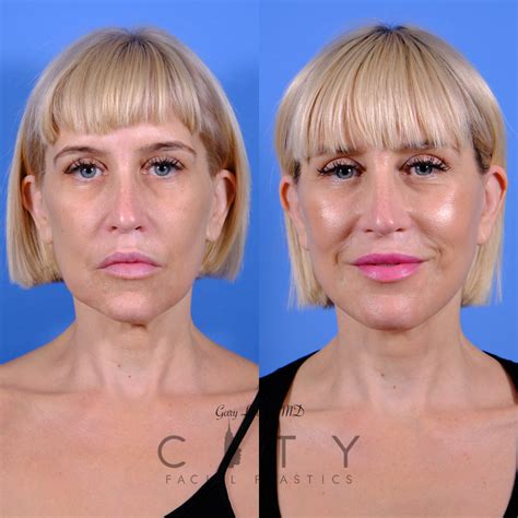 alternative   facelift  tayla bruton blog