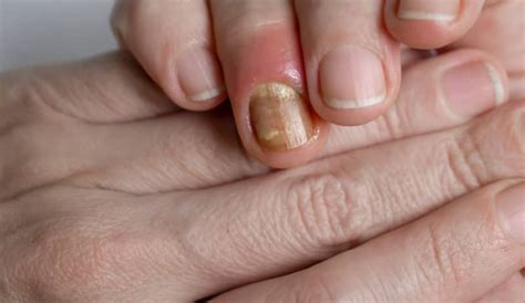 Uñas con hongos, lo que necesitas saber | DKV