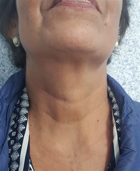 Patients - Spinal Surgery Mexico