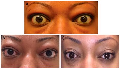 life  full text thyroid eye disease