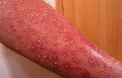 Pellagra - Definition of Pellagra