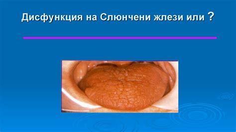 Симптомът ксеростомия – сухота в устата - презентация онлайн