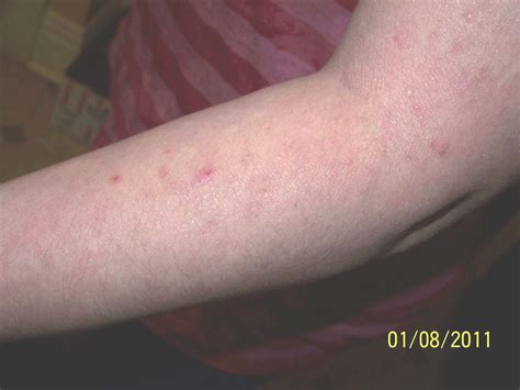 VIRTUAL GRAND ROUNDS IN DERMATOLOGY 2.0: Brachioradial Pruritus