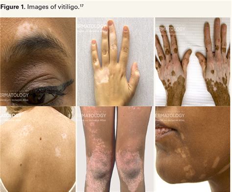 shining  light  vitiligo   comorbidities