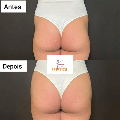 Ácido Hialurônico No Glúteo Antes E Depois