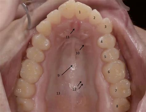 palatum dentes diagram quizlet
