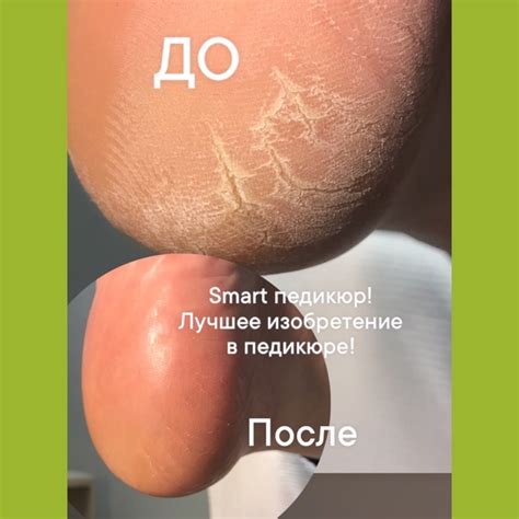 Пятки как у младенца! Надо, всего лишь, записаться на Смарт педикюр 珞 ...