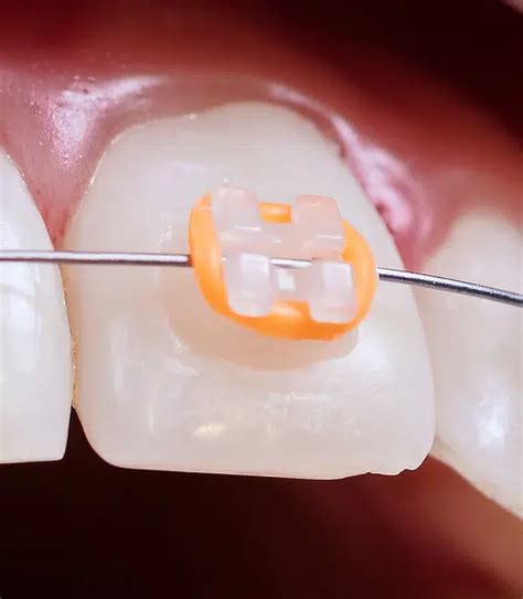 how to open bracket braces