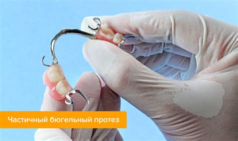 Вставная челюсть - фото, виды съемных челюстей, как их изготавливают?