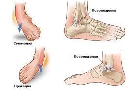 Фиксирующая повязка на голеностоп: эластичный бинт, ортез, бандаж, тутор