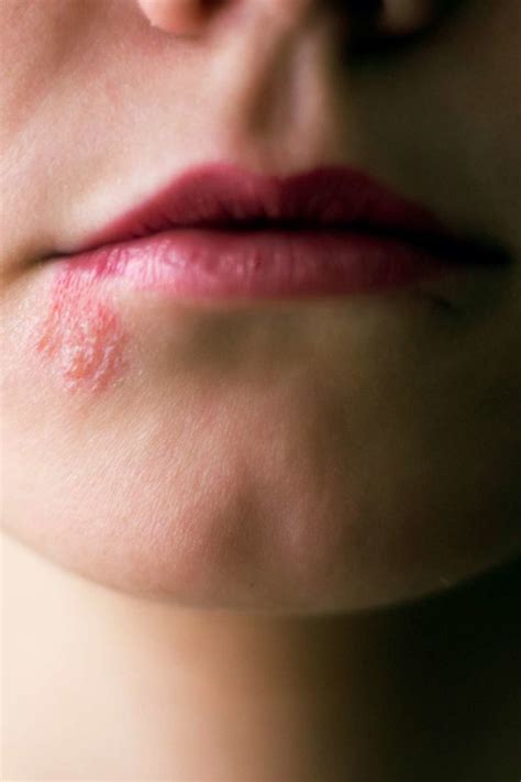 Shingles