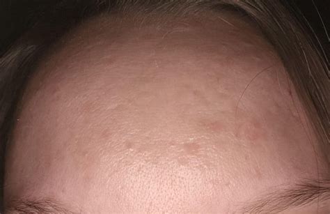 Forehead acne scars : r/AcneScars