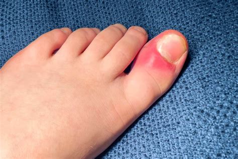 Curing Ingrown Toenails - Well Heeled Podiatry