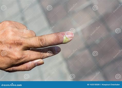 Bebê Com Dedo Inchado E Vermelho - Paroníquia, Dedo Inchado Com Inflamação Do Leito Das Unhas Devido a ...