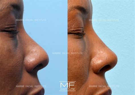 4 Ways To Make Your Nose Appear Smaller With Filler | Mabrie Facial