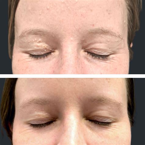 Skincare experts clash over the best way to extract big blackheads 24