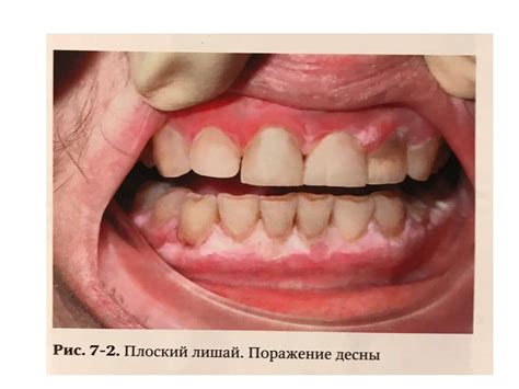 Изменения слизистой оболочки рта при дерматозах. Красный плоский лишай ...