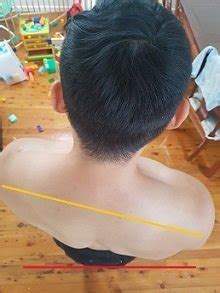 fix  twisted spine posture direct