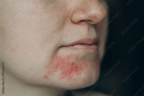Photo & Art Print Perioral dermatitis on woman face, mdyn