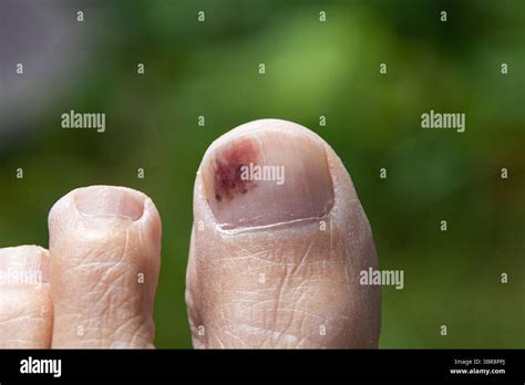 Close-up of a bruised big toe with visible subungual bruising under the ...