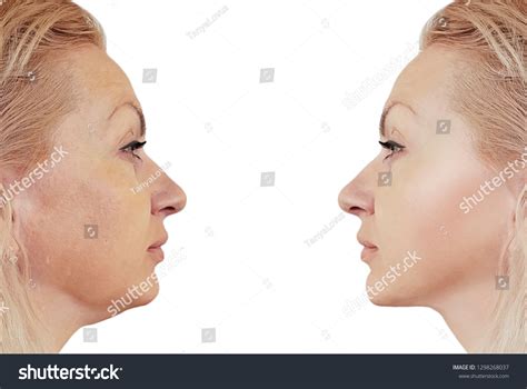 Woman Double Chin Before After Procedures Stock Photo (Edit Now) 1298268037