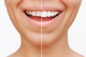 treatments   small teeth larger dental group west blog dental