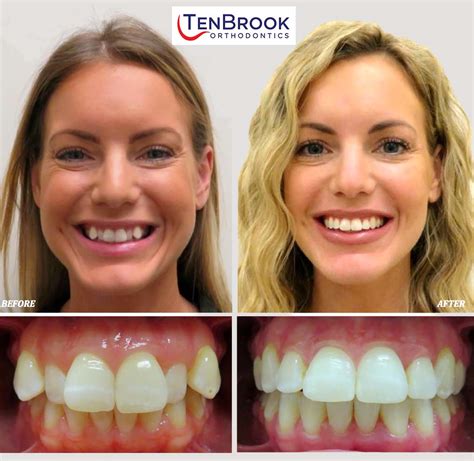 Braces Before And After Smile