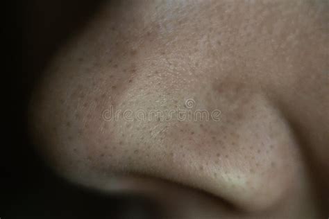 Black Dots on the Nose. Close Up Stock Photo - Image of cosmetology, dots: 166470706