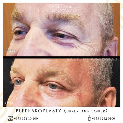 Blepharoplasty Gallery - Smile Studios - Best Medical Center in Bahrain ...