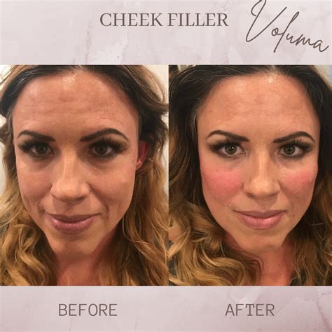 Cheek Filler - Eluma - Laser & Aesthetics