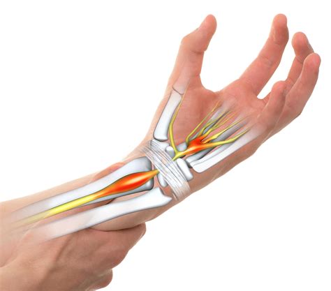 Carpal Tunnel Syndrome Specialist - Palm Harbor, FL: Orthopedic Specialists: Orthopedic Surgeon