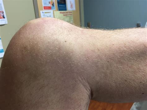 The Sag Sign: Posterior Cruciate Ligament Injury of the Knee ...