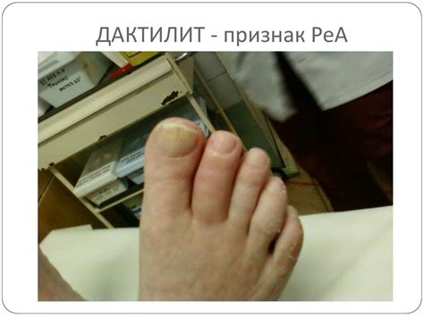 Реактивный артрит - презентация онлайн