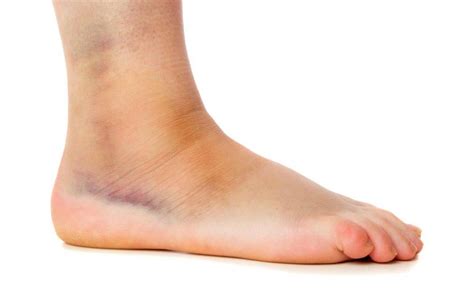 A Sprained Ankle : The facts and how to heal fully and fast
