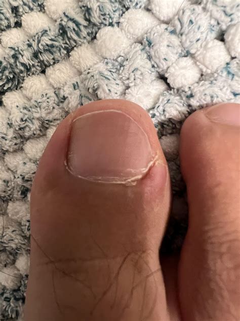 My first ingrown toenail. Getting it seen this week. Ready for the pain