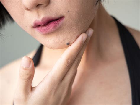 Mole vs. freckle: Understanding moles and freckles