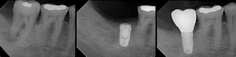 state   art  implant therapy intechopen