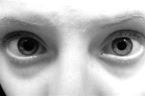 Concussion, pupils different sizes [UPDATE] I was feeling dizzy, hit the back of my head on an ...