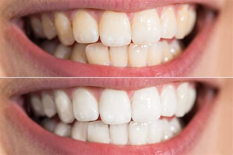 Natural Teeth Whitening Methods, Brighten Your Smile | Manfield Group ...