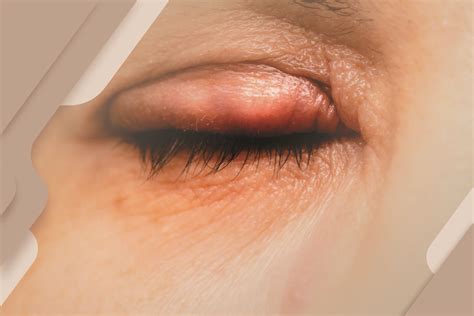 Inchaço Nos Olhos E Dor De Cabeça - Conheça as principais causas de inchaço no olho. Veja quando é grave e ...