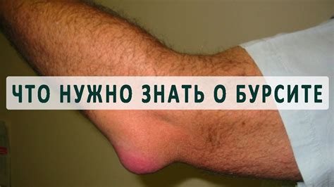 Причины, симптомы и лечение бурсита - YouTube
