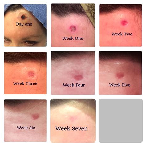 Skin Graft Healing Stages Pictures at Victor Bartlett blog