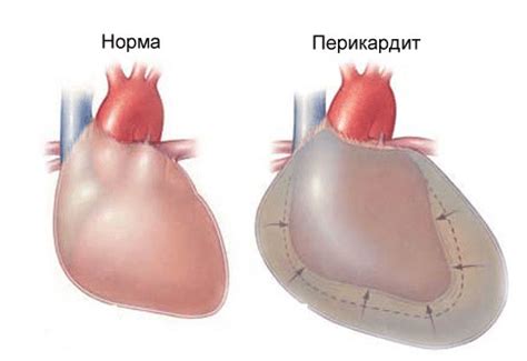 Перикардит