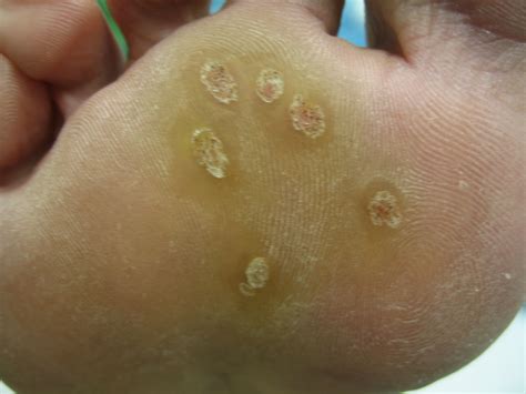 Young Plantar Warts